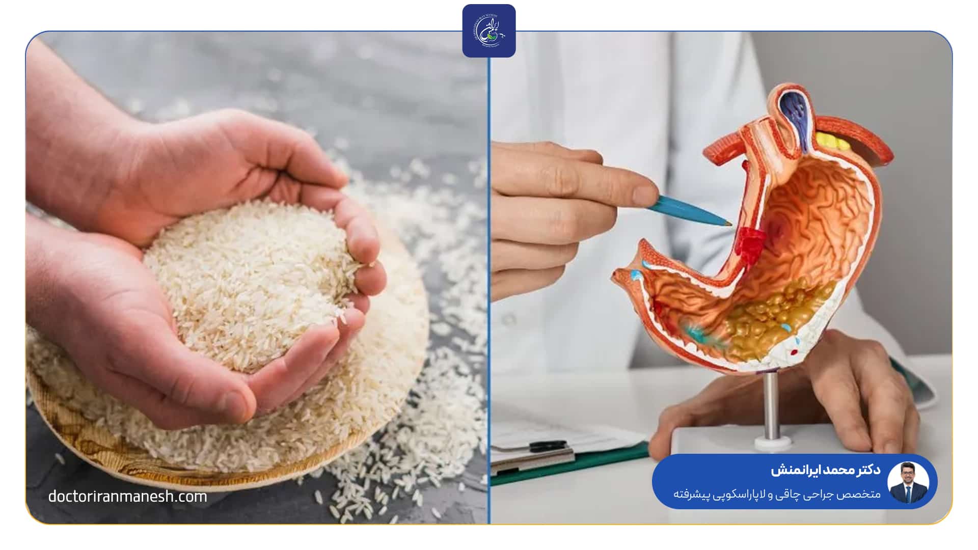 زمان مصرف نان بعد از اسلیو معده
