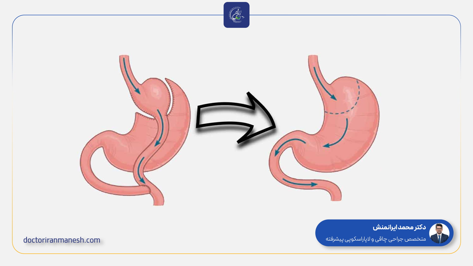 نکاتی برای کاهش عوارض بای پس معده