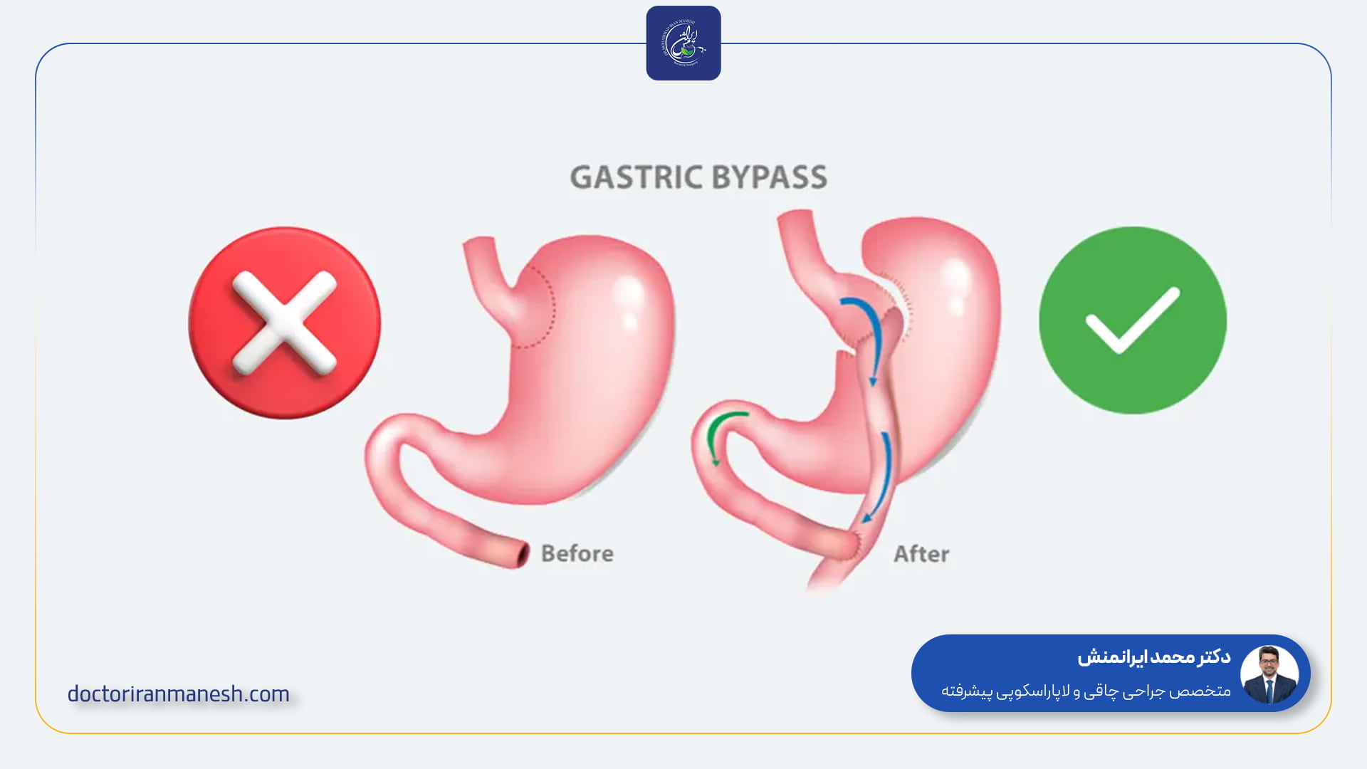 عوارض جراحی بای پس معده