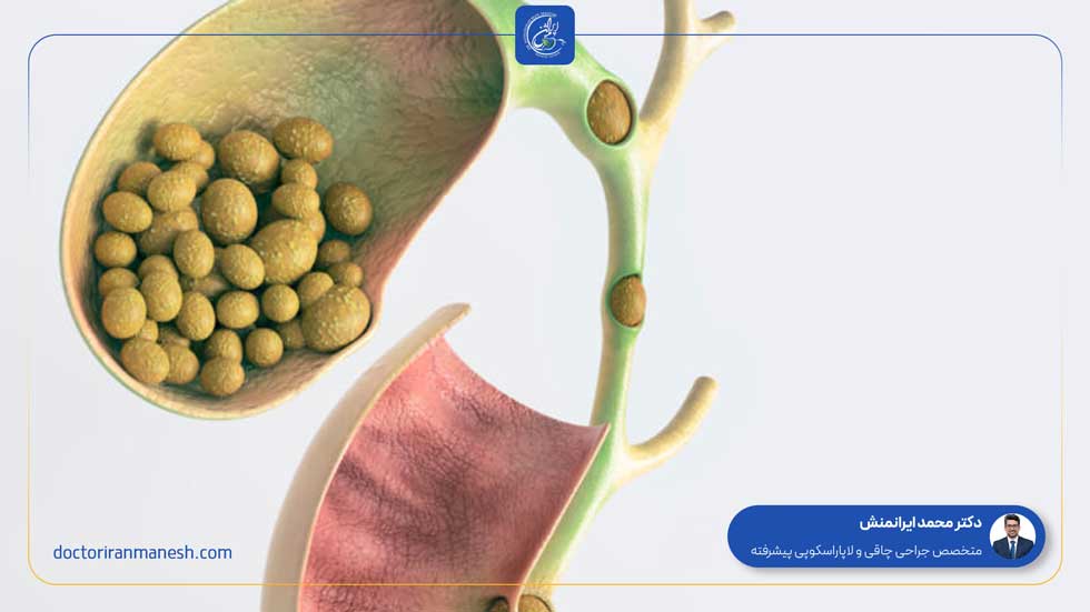 علت تشکیل سنگ کیسه صفرا چیست؟