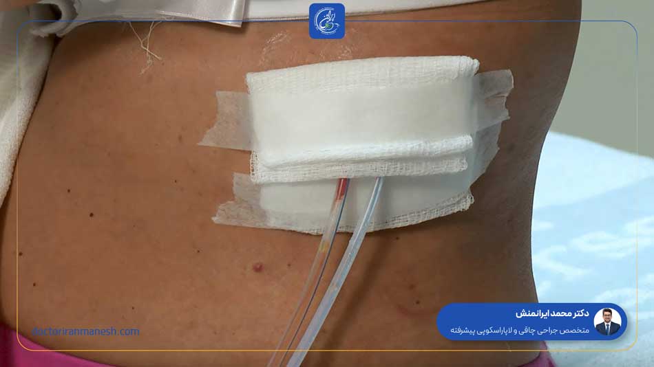 درن اسلیو معده چه زمانی کشیده میشود؟