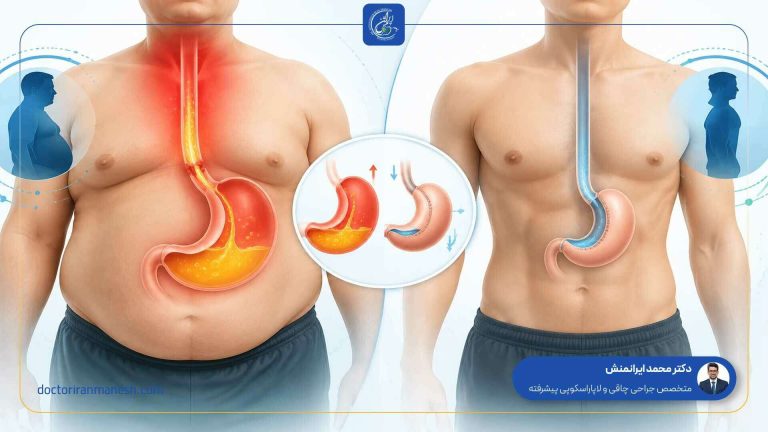 ارتباط رفلاکس اسید معده با جراحی چاقی