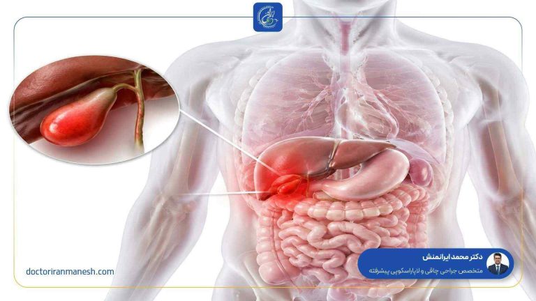 علائم پر شدن کیسه صفرا