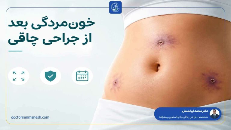 خون مردگی بعد از جراحی چاقی