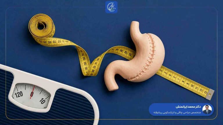 روند کاهش وزن بعد از اسلیو معده