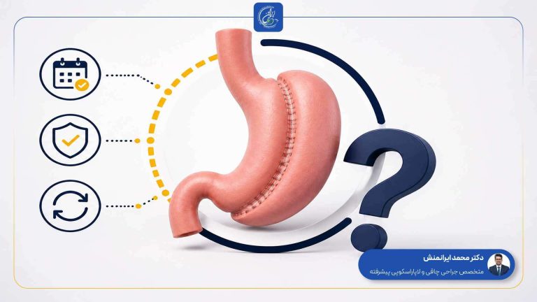 آیا اسلیو معده دائمی است؟