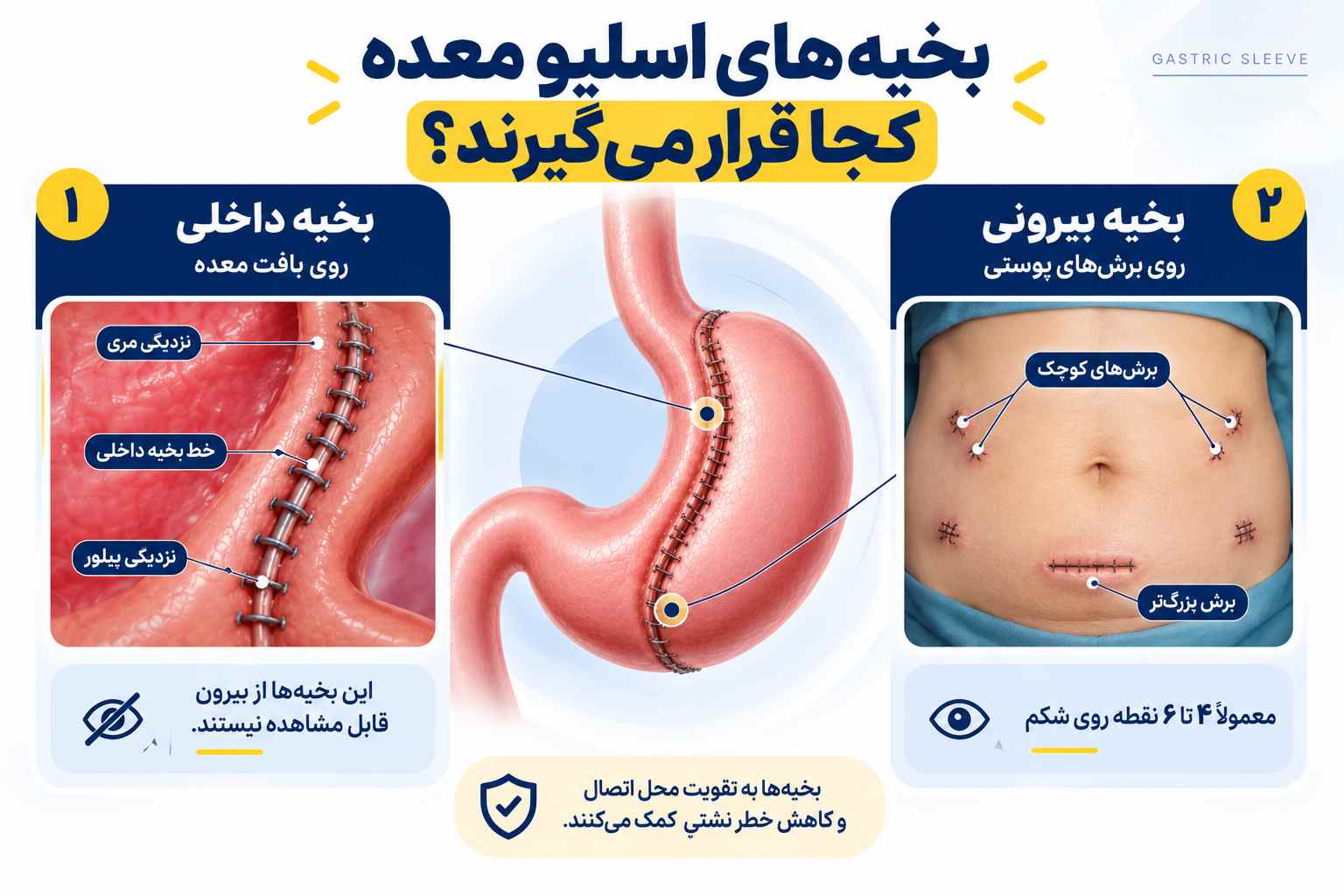 بخیههای اسلیو معده