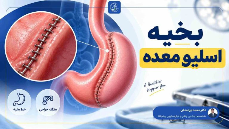 بخیه اسلیو معده