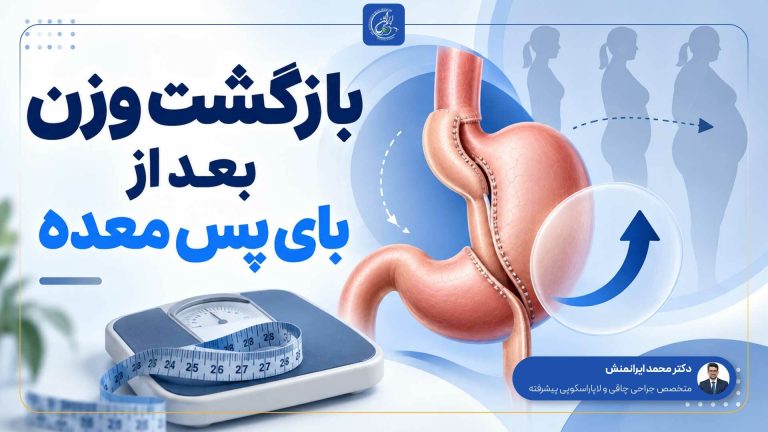 بازگشت وزن بعد از بای پس معده