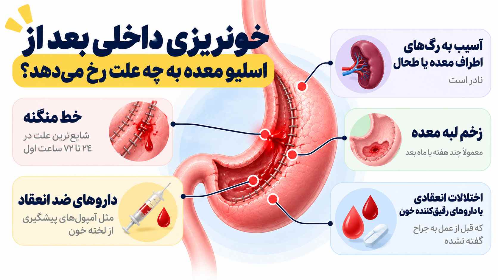 خونریزی داخلی بعد از اسلیو معده به چه علت رخ میدهد؟