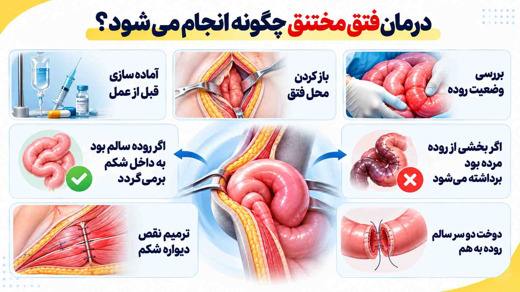درمان فتق مختنق
